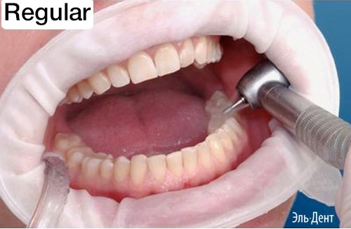 OptraGate  Regular стандартные, 1шт.,  Ivoclar. 1231910869 - фото 445721