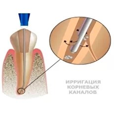 Шприц эндодонтический SITEKMED (игла 0,3х25мм) с боковым отверстием