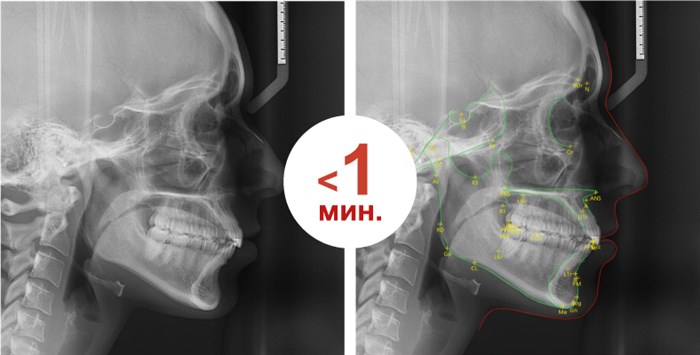 Програмный модуль EzOrtho для цефалометрического анализа, Vatech EzOrtho - фото 357534