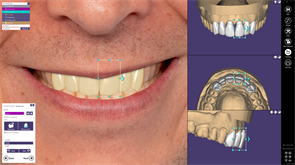 Модуль Exocad Smile Creator. Модуль планирования улыбки SmileCreator