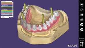 Модуль Exocad Implant module. Имплант модуль Implantmodule