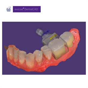 Обновления программного обеспечения для Exocad, модуль In-CAD Nesting 265317