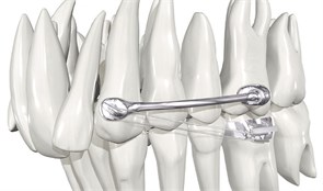 Аппарат Carriere Motion 3D Colors 2 Class Silver для коррекции Класса 2, набор, длина 20 мм 75085