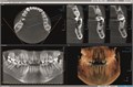 Томограф Orthopantomograph KAVO DEXIS OP 3D Pro Ceph область 3D сканирования 8x15 см с цефалостатом 0.805.5600 - фото 356695