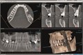 Томограф Orthopantomograph KAVO DEXIS OP 3D Pro область 3D сканирования 8x15 см 0.805.5500 - фото 356736