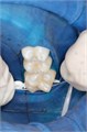 OptraDam Regular (1 шт.), Ivoclar 0001912339 - фото 460970