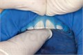 OptraDam Small 1шт., Ivoclar 0001912373 - фото 460975