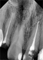 Радиовизиограф Rayence Vatech EzSensor размер 1.5 intraoral - фото 475002