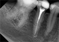 Радиовизиограф Rayence Vatech EzSensor размер 1.5 intraoral - фото 475004