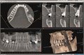 Томограф Orthopantomograph KAVO DEXIS OP 3D Pro область 3D сканирования 13x15 см 0.805.550013x15 - фото 475504