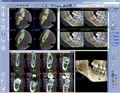 Томограф Planmeca ProMax 3D Classic без цефалостата. 10019566 - фото 476763