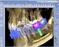 Томограф Planmeca ProMax 3D Plus без цефалостата 10032801 - фото 476780