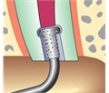 KaVo SONICflex retro - набор алмазных насадок со штопферами для щадящего препарирования ретроградных полостей 0.571.0381 - фото 504488