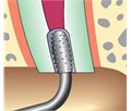 KaVo SONICflex retro - набор алмазных насадок со штопферами для щадящего препарирования ретроградных полостей 0.571.0381 - фото 504491